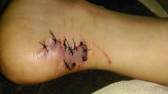 اصابة الطفل بسبب حمام السباحة